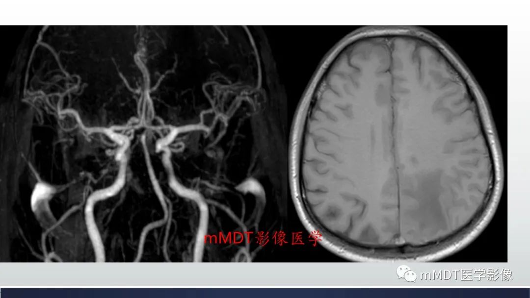 影像PPT - 【PPT】神经梅毒病例分析及图文综述-34