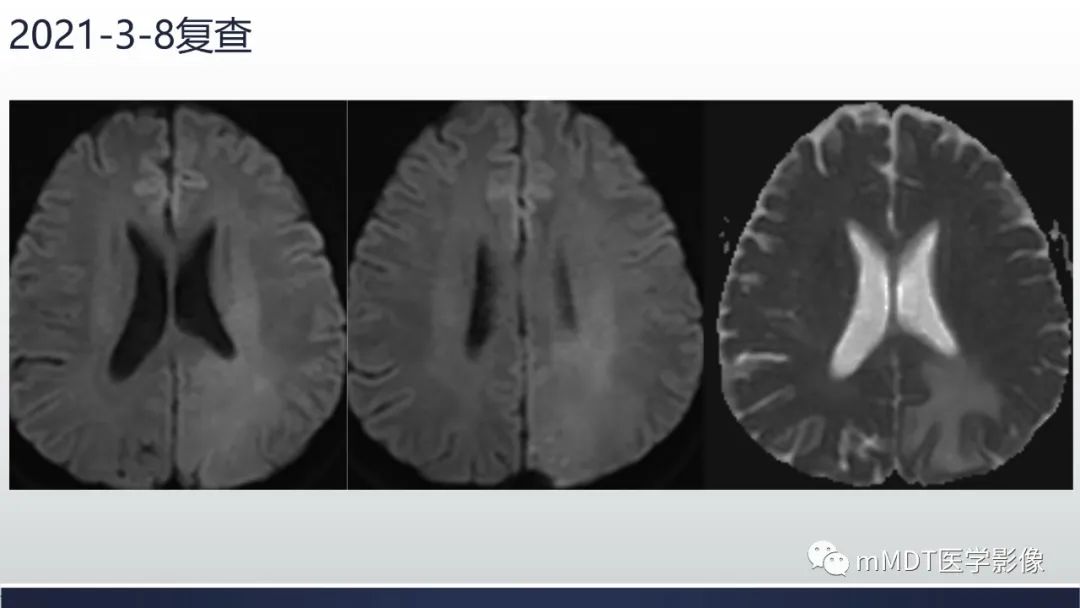 影像PPT - 【PPT】神经梅毒病例分析及图文综述-40
