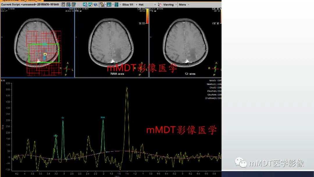 影像PPT - 【PPT】神经梅毒病例分析及图文综述-37