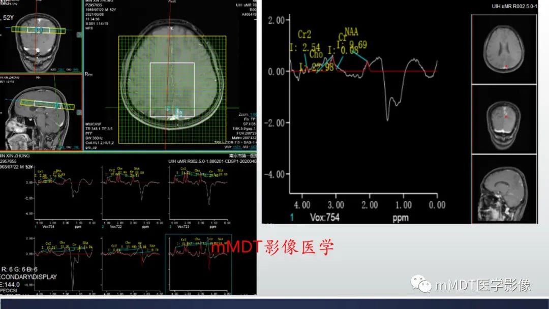 影像PPT - 【PPT】神经梅毒病例分析及图文综述-47