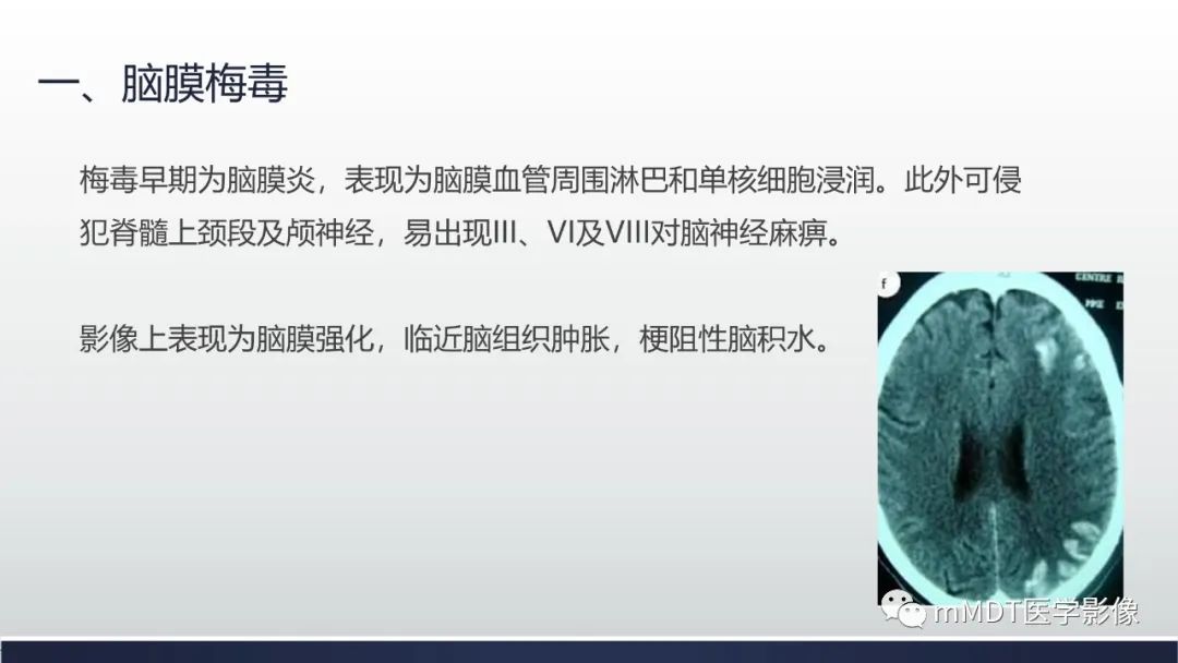 影像PPT - 【PPT】神经梅毒病例分析及图文综述-52