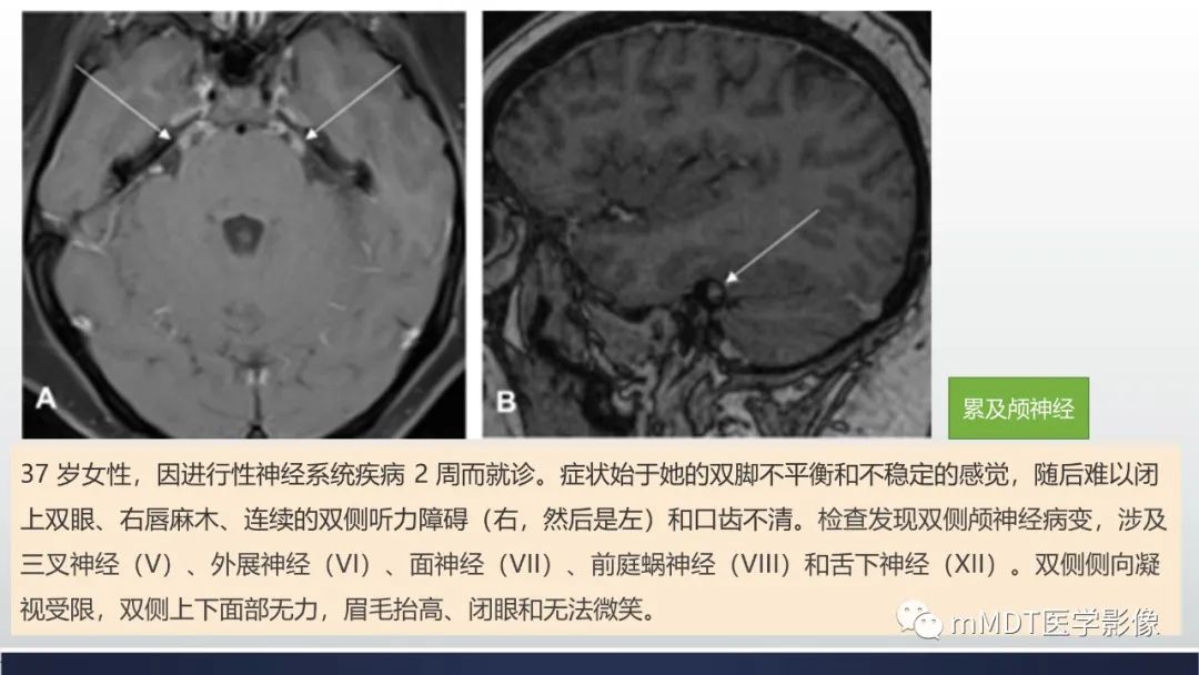 影像PPT - 【PPT】神经梅毒病例分析及图文综述-54