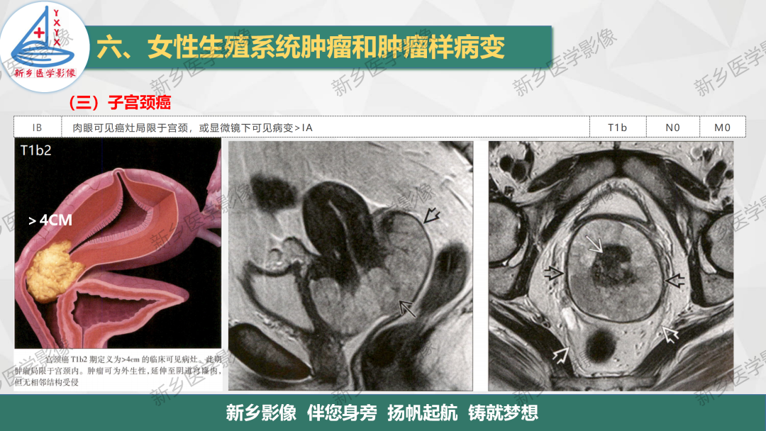 影像PPT - 【PPT】宫颈癌及子宫内膜异位症的影像表现-7