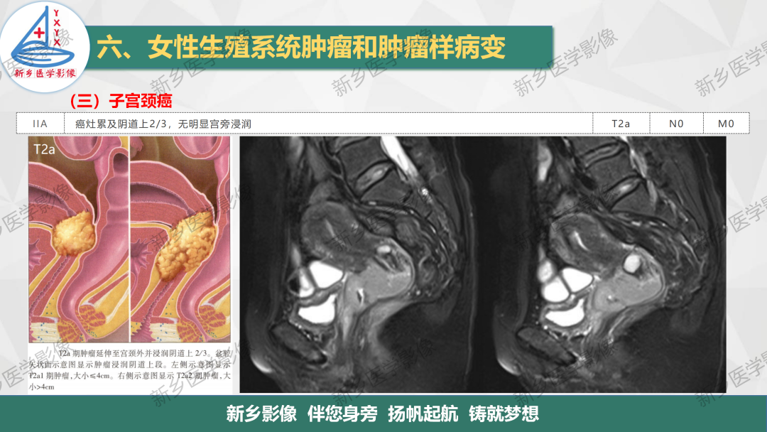 影像PPT - 【PPT】宫颈癌及子宫内膜异位症的影像表现-8
