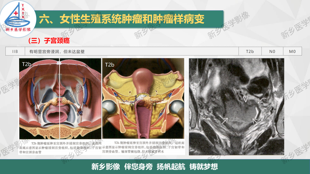 影像PPT - 【PPT】宫颈癌及子宫内膜异位症的影像表现-9