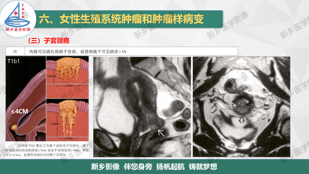 影像PPT - 【PPT】宫颈癌及子宫内膜异位症的影像表现-6