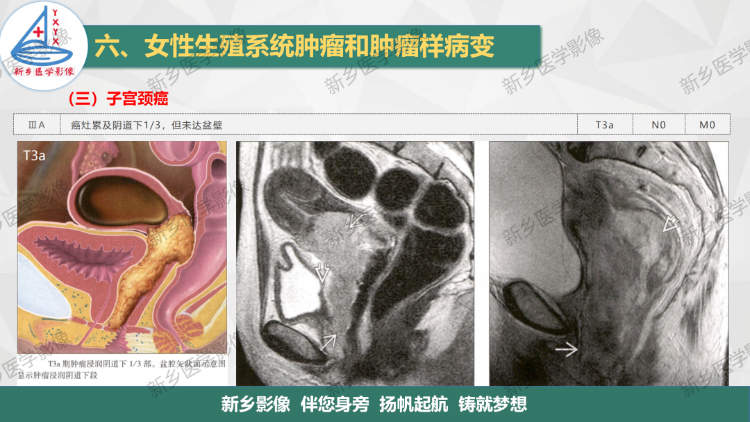 影像PPT - 【PPT】宫颈癌及子宫内膜异位症的影像表现-10