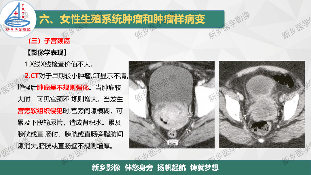 影像PPT - 【PPT】宫颈癌及子宫内膜异位症的影像表现-3