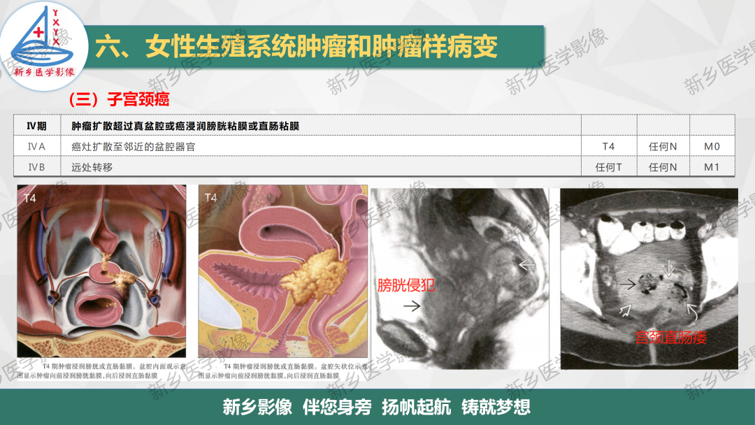 影像PPT - 【PPT】宫颈癌及子宫内膜异位症的影像表现-12