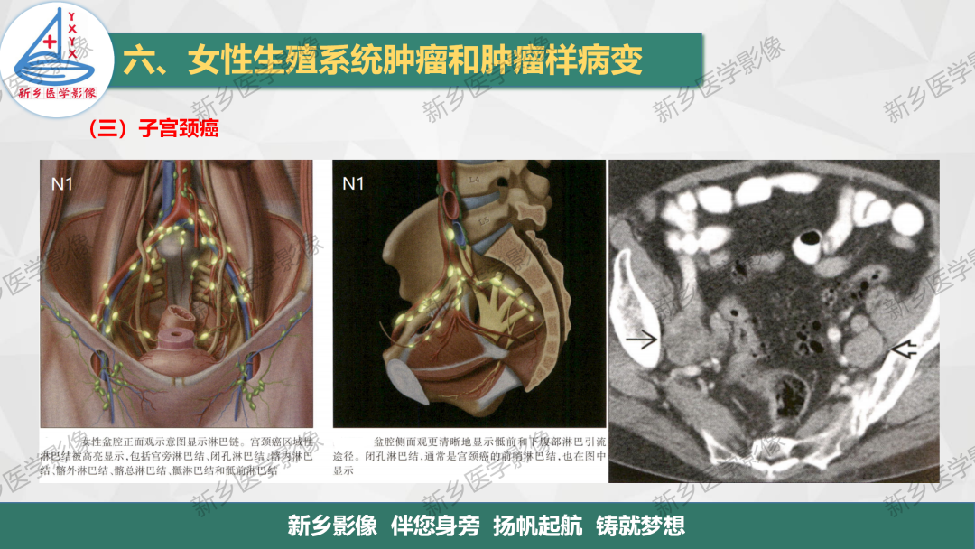 影像PPT - 【PPT】宫颈癌及子宫内膜异位症的影像表现-13