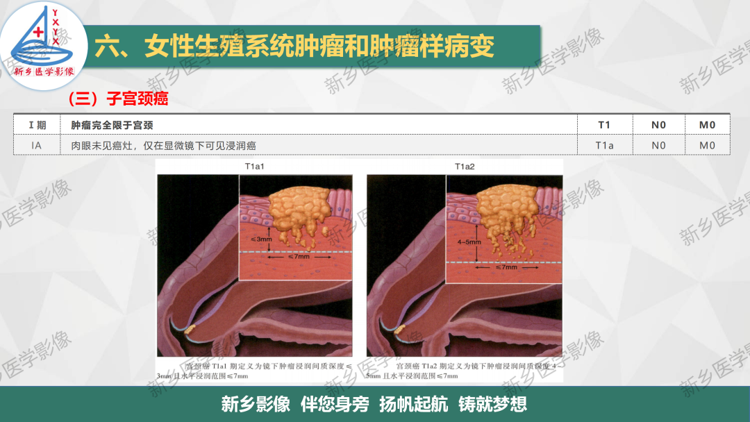 影像PPT - 【PPT】宫颈癌及子宫内膜异位症的影像表现-5