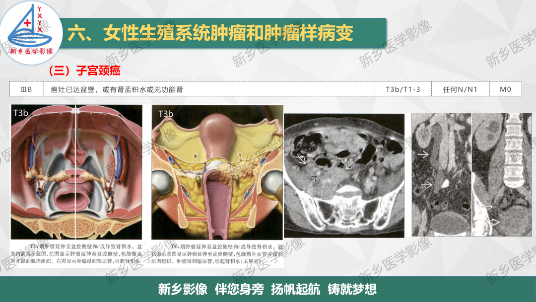 影像PPT - 【PPT】宫颈癌及子宫内膜异位症的影像表现-11