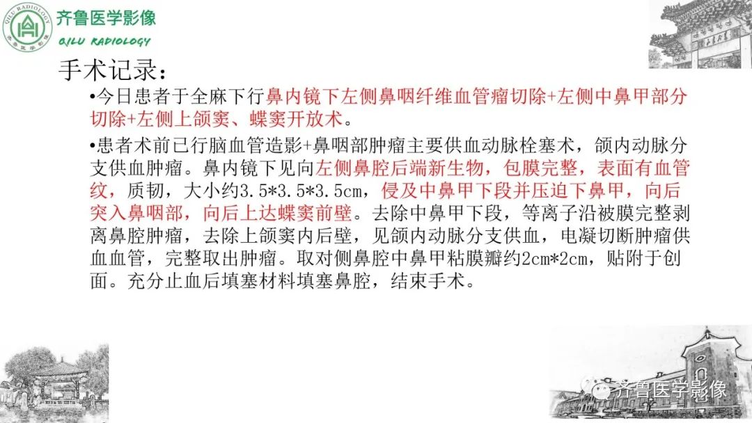 影像PPT - 【病例】鼻咽纤维血管瘤3例CT及MR影像-15