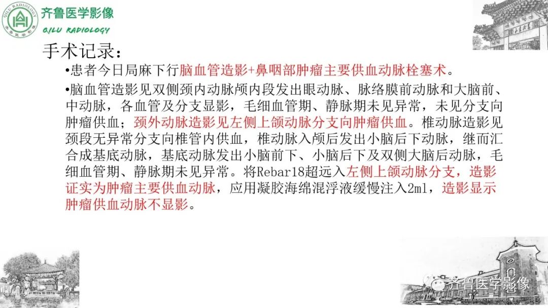 影像PPT - 【病例】鼻咽纤维血管瘤3例CT及MR影像-14