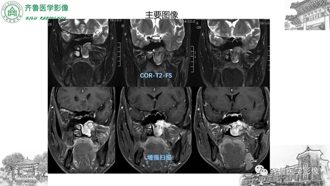 影像PPT - 【病例】鼻咽纤维血管瘤3例CT及MR影像-18