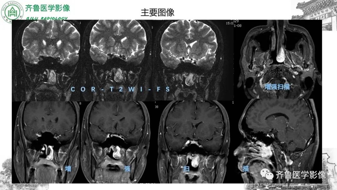 影像PPT - 【病例】鼻咽纤维血管瘤3例CT及MR影像-11