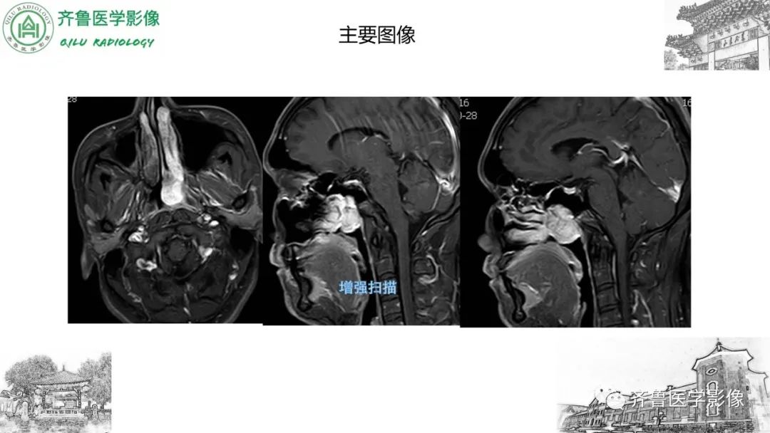 影像PPT - 【病例】鼻咽纤维血管瘤3例CT及MR影像-19