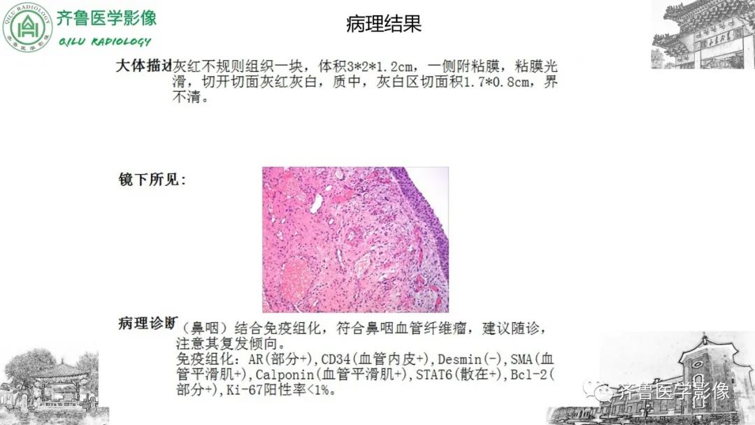 影像PPT - 【病例】鼻咽纤维血管瘤3例CT及MR影像-6