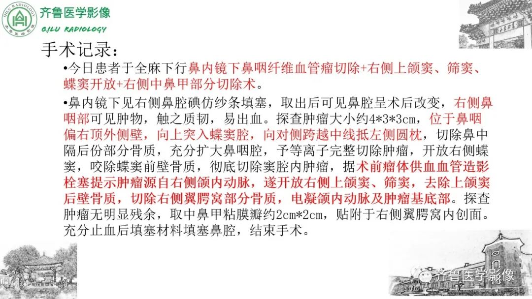 影像PPT - 【病例】鼻咽纤维血管瘤3例CT及MR影像-8