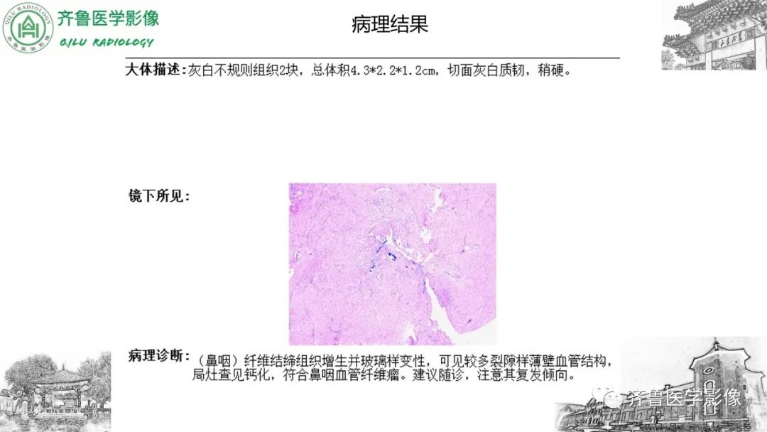 影像PPT - 【病例】鼻咽纤维血管瘤3例CT及MR影像-20
