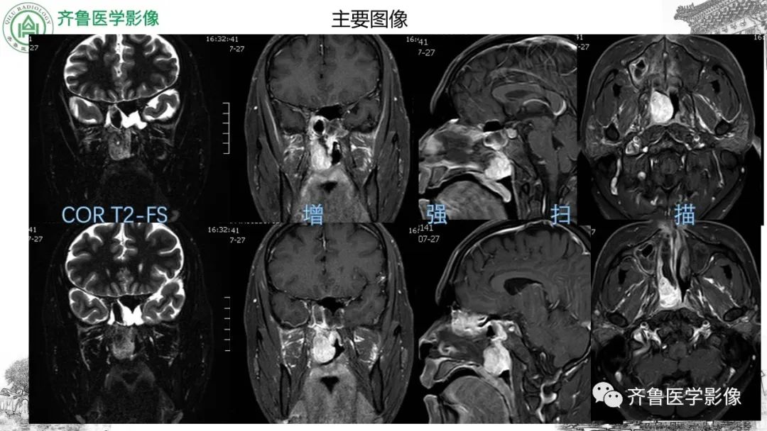 影像PPT - 【病例】鼻咽纤维血管瘤3例CT及MR影像-4