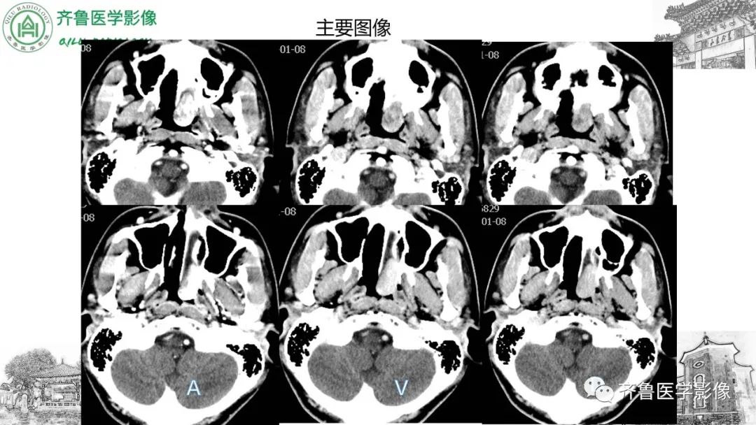 影像PPT - 【病例】鼻咽纤维血管瘤3例CT及MR影像-12