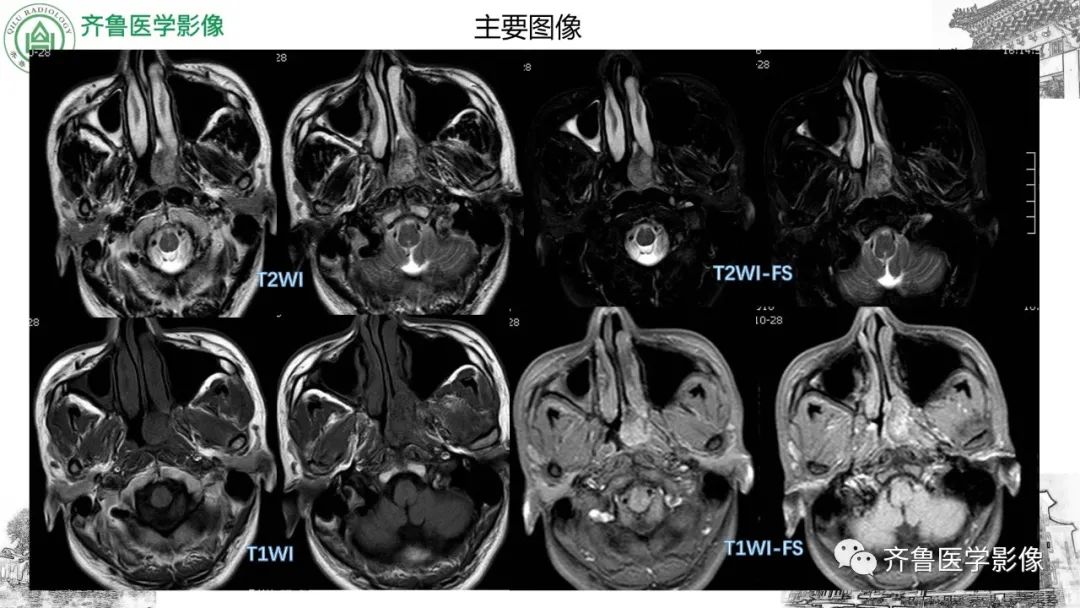 影像PPT - 【病例】鼻咽纤维血管瘤3例CT及MR影像-17