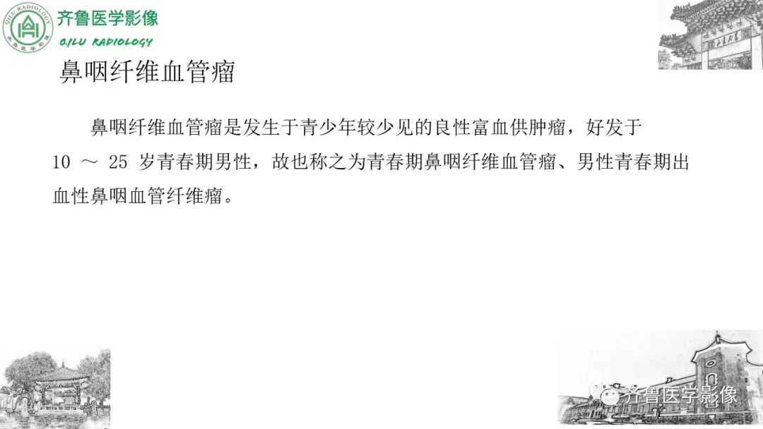 影像PPT - 【病例】鼻咽纤维血管瘤3例CT及MR影像-23