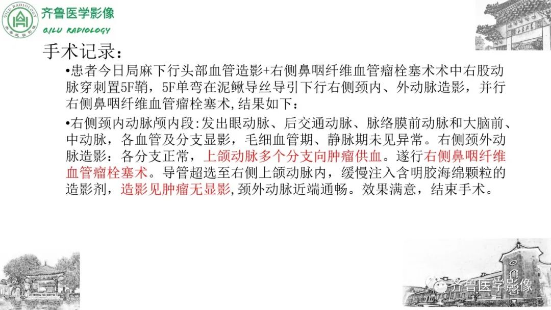 影像PPT - 【病例】鼻咽纤维血管瘤3例CT及MR影像-7