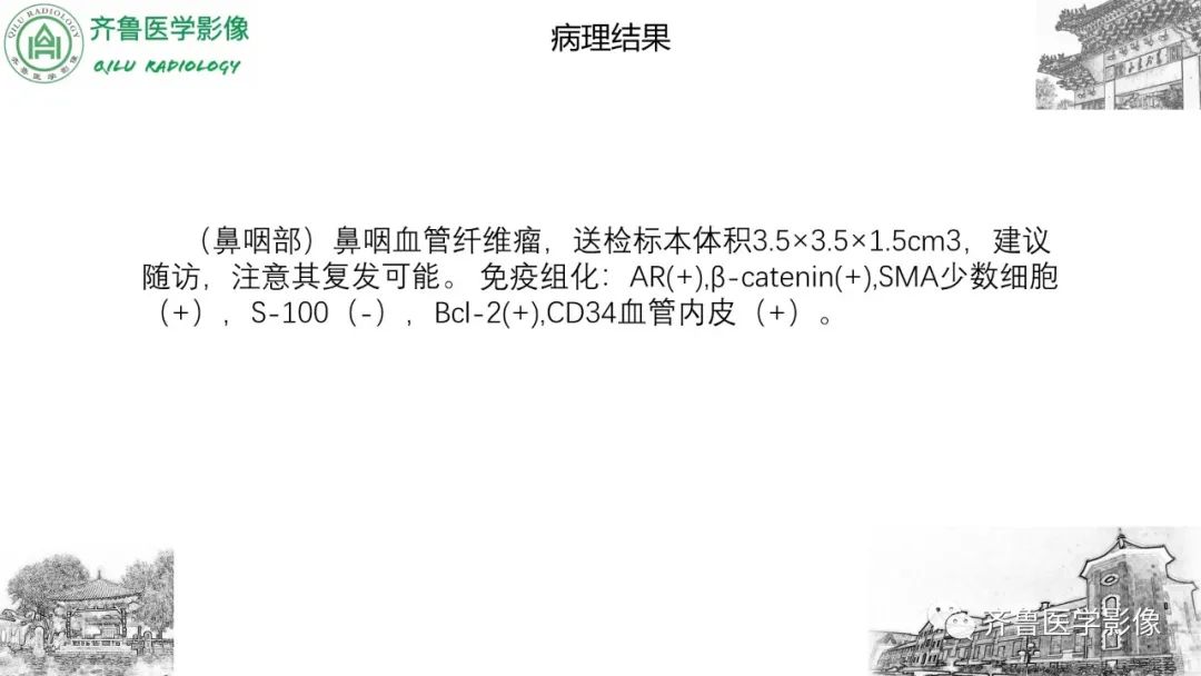 影像PPT - 【病例】鼻咽纤维血管瘤3例CT及MR影像-13