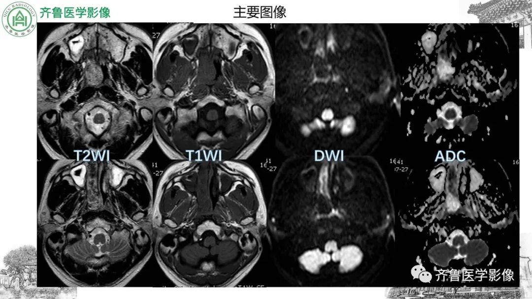 影像PPT - 【病例】鼻咽纤维血管瘤3例CT及MR影像-3