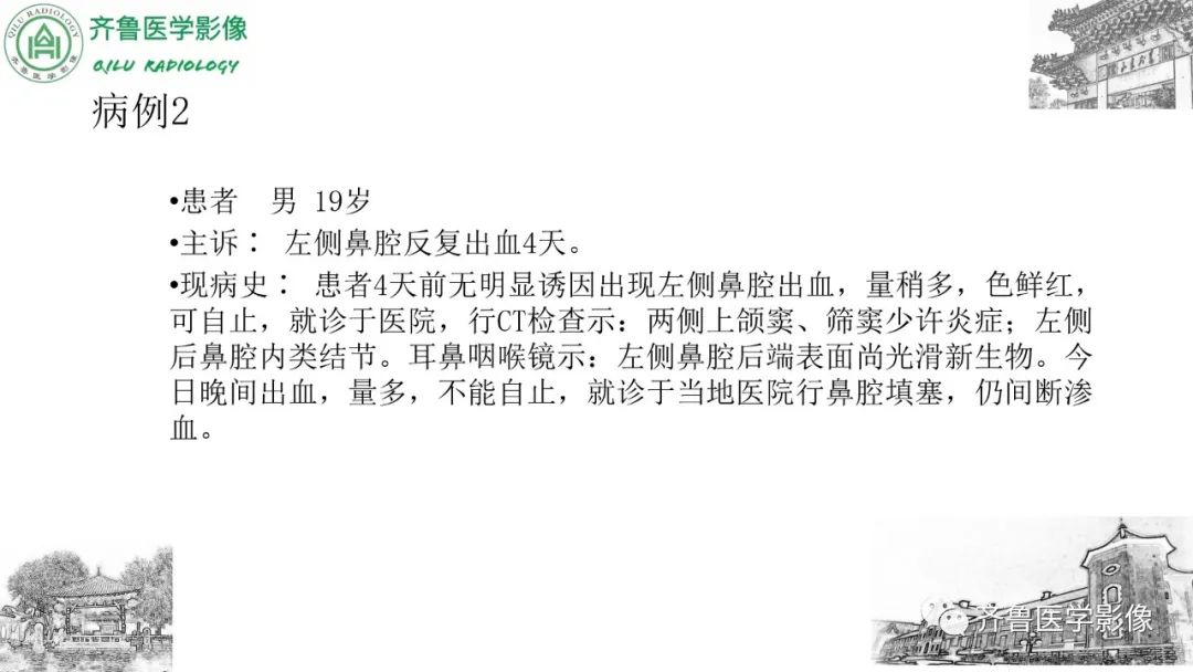 影像PPT - 【病例】鼻咽纤维血管瘤3例CT及MR影像-9