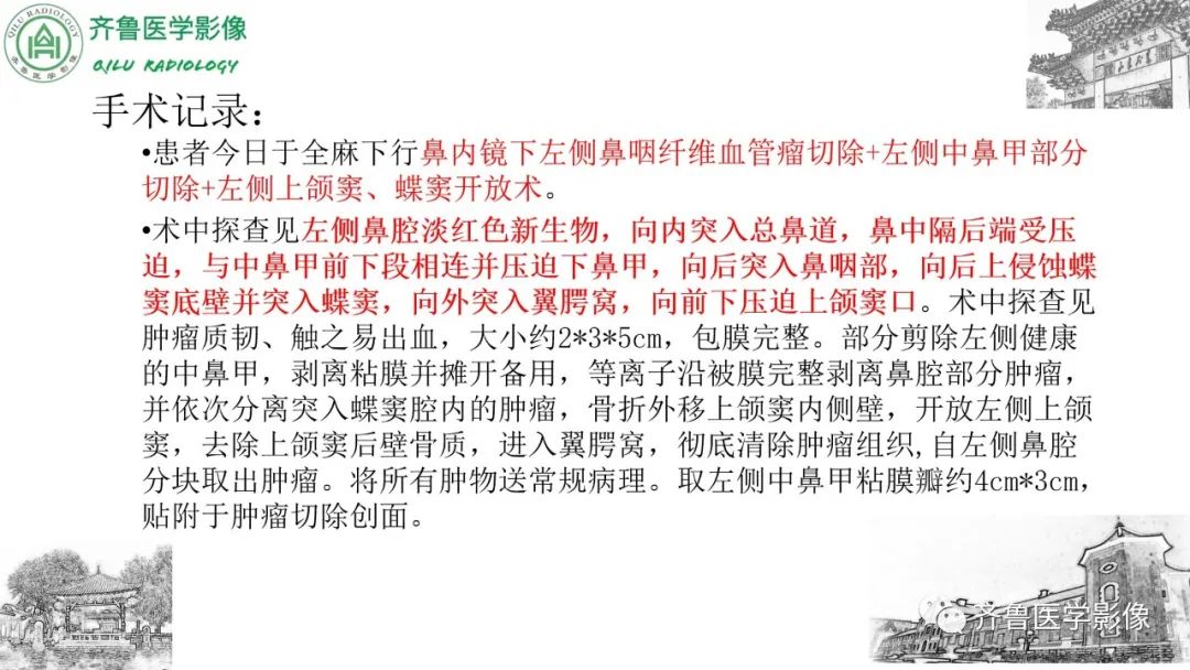 影像PPT - 【病例】鼻咽纤维血管瘤3例CT及MR影像-22