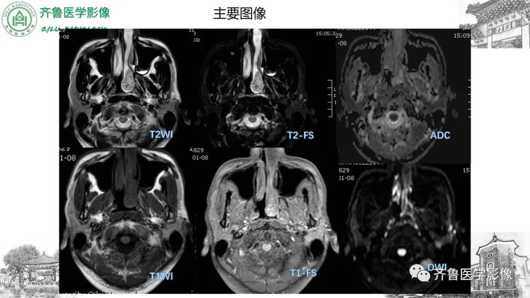 影像PPT - 【病例】鼻咽纤维血管瘤3例CT及MR影像-10