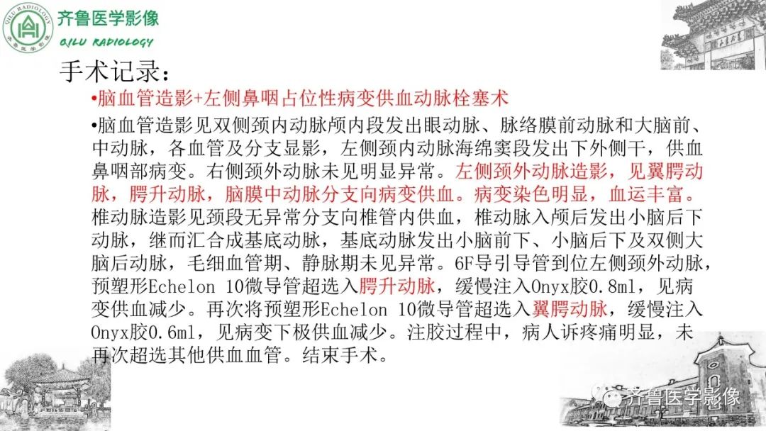 影像PPT - 【病例】鼻咽纤维血管瘤3例CT及MR影像-21