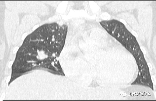 影像PPT - 【病例】一例女性肺淋巴瘤样肉芽肿并文献复习-13 影像PPT - 【病例】一例女性肺淋巴瘤样肉芽肿并文献复习-13