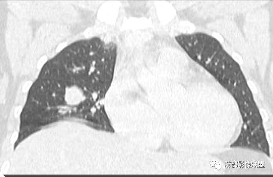 影像PPT - 【病例】一例女性肺淋巴瘤样肉芽肿并文献复习-14 影像PPT - 【病例】一例女性肺淋巴瘤样肉芽肿并文献复习-14
