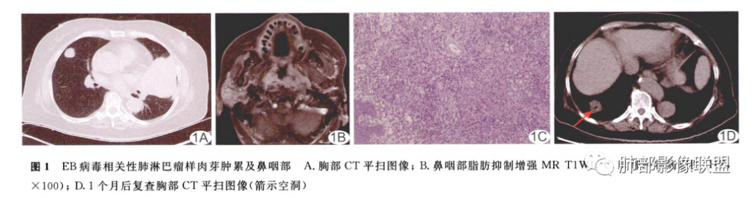 影像PPT - 【病例】一例女性肺淋巴瘤样肉芽肿并文献复习-35
