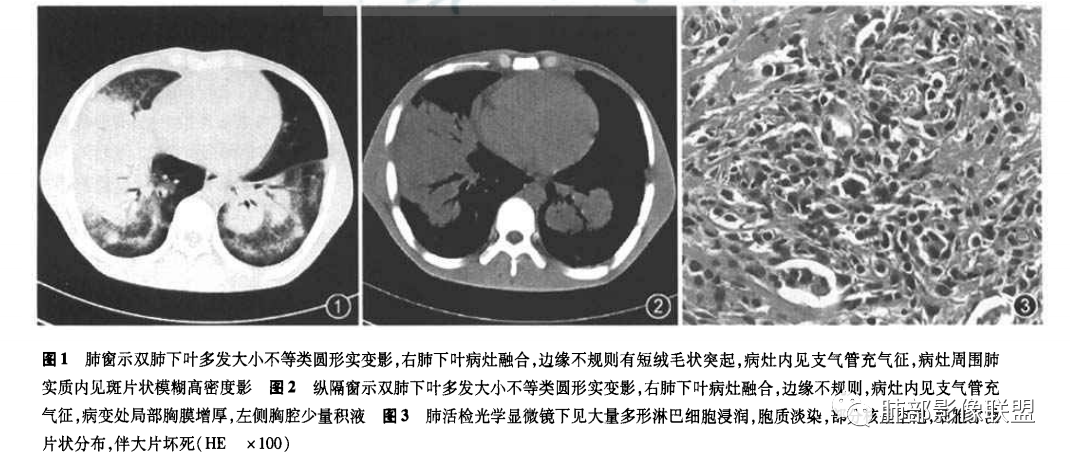 影像PPT - 【病例】一例女性肺淋巴瘤样肉芽肿并文献复习-42
