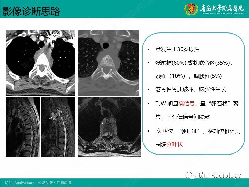 影像PPT - 【病例】胸椎脊索瘤1例CT及MR影像-9
