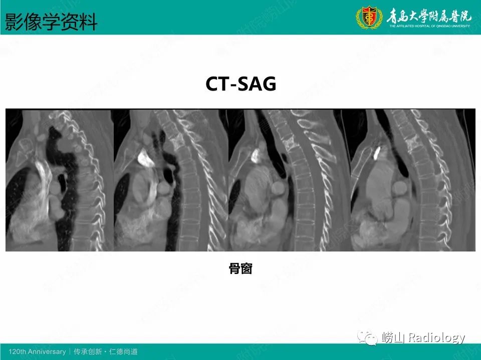 影像PPT - 【病例】胸椎脊索瘤1例CT及MR影像-4