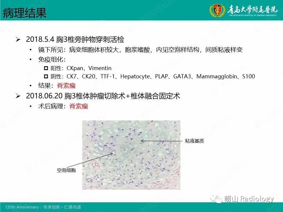 影像PPT - 【病例】胸椎脊索瘤1例CT及MR影像-8