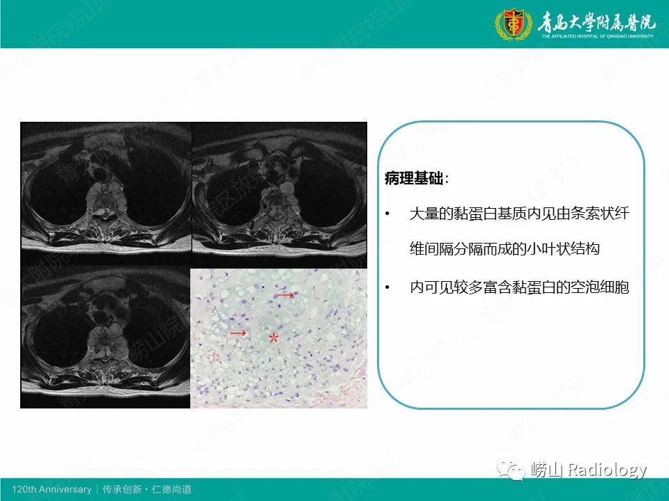 影像PPT - 【病例】胸椎脊索瘤1例CT及MR影像-10