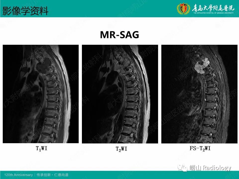 影像PPT - 【病例】胸椎脊索瘤1例CT及MR影像-5