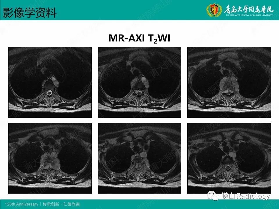 影像PPT - 【病例】胸椎脊索瘤1例CT及MR影像-6