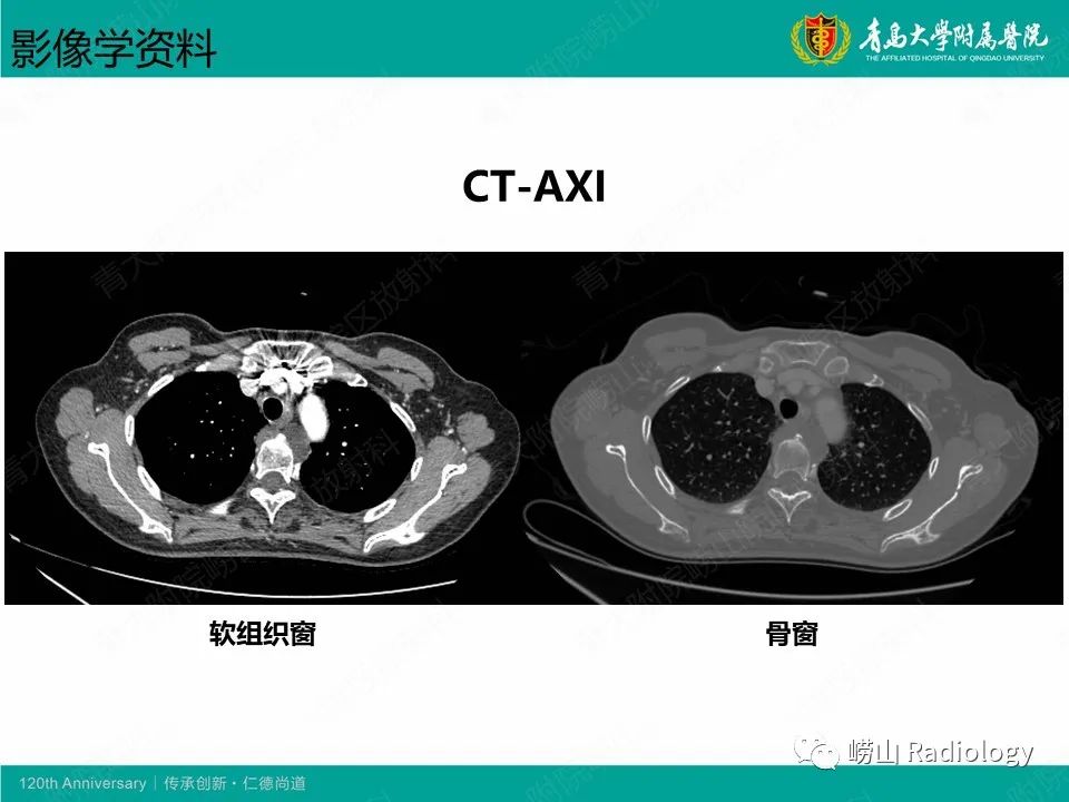 影像PPT - 【病例】胸椎脊索瘤1例CT及MR影像-3