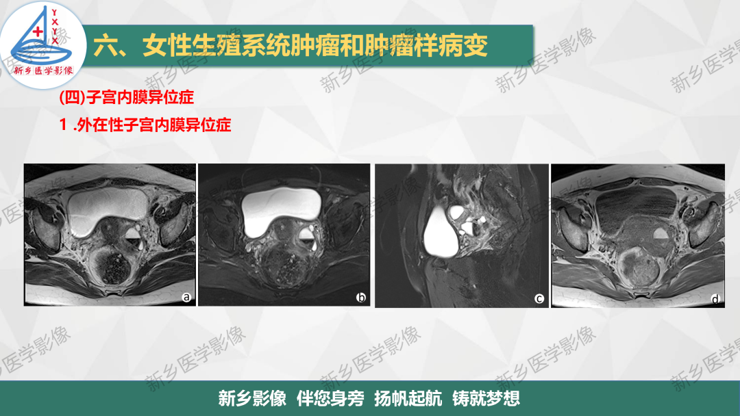 影像PPT - 【PPT】宫颈癌及子宫内膜异位症的影像表现-4