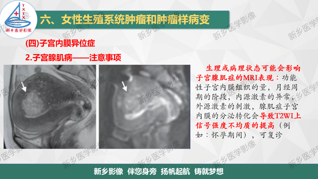 影像PPT - 【PPT】宫颈癌及子宫内膜异位症的影像表现-9