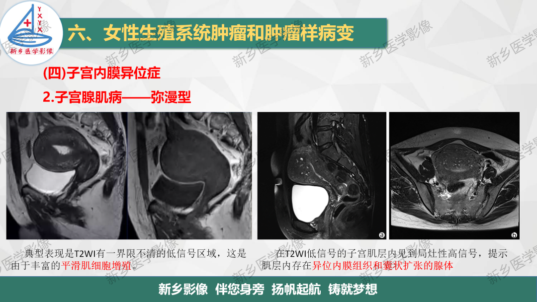 影像PPT - 【PPT】宫颈癌及子宫内膜异位症的影像表现-7