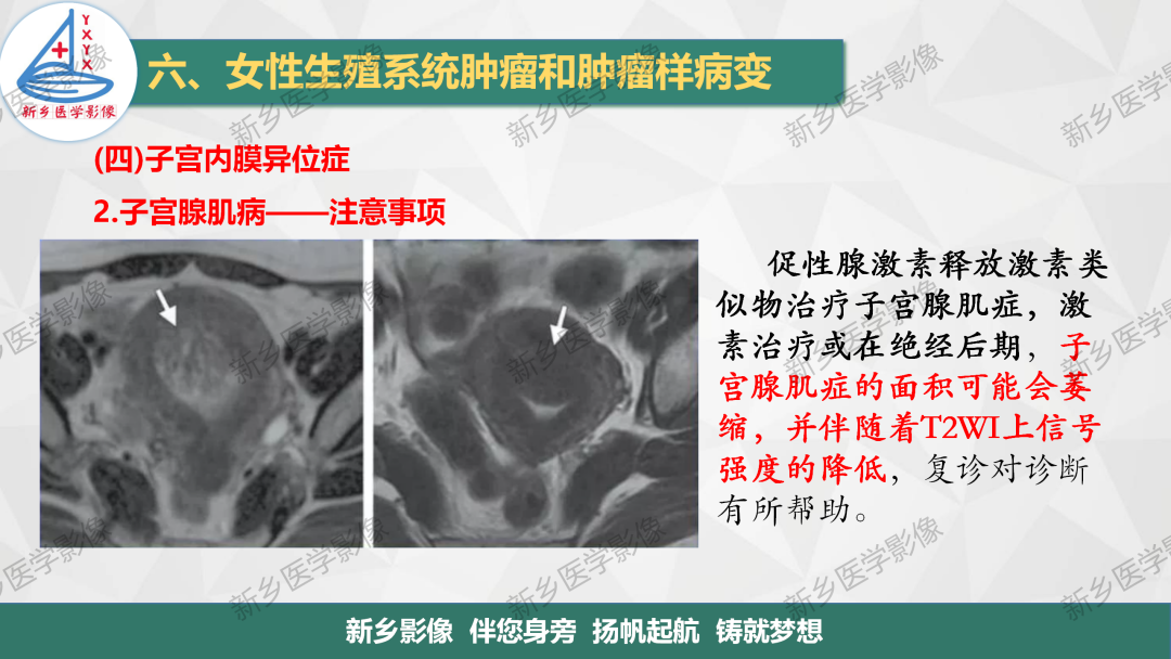 影像PPT - 【PPT】宫颈癌及子宫内膜异位症的影像表现-10